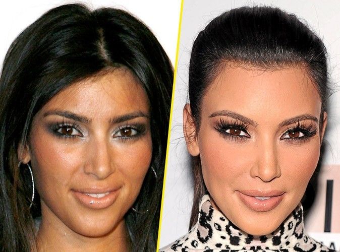 Kim Kardashian avant et après la chirurgie